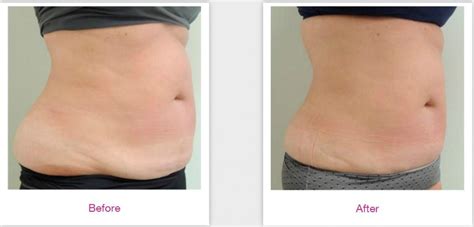 Velashape Reviews .